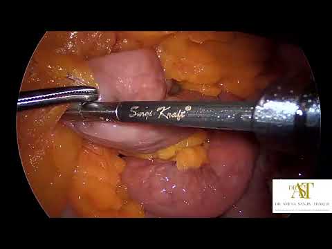 Laparoscopic Mini Gastric Bypass : Tribute to Dr Rutledge