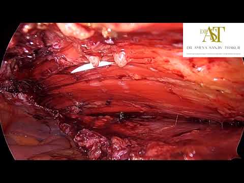 Laparoscopic Hybrid eTEP RS with B/L TAR in complex recurrent ventral hernia