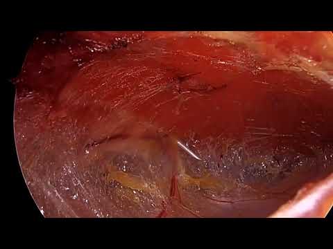 Four Back-to-Back Advanced Laparoscopic Abdominal Wall Reconstructions by Dr. Ameya Thakur