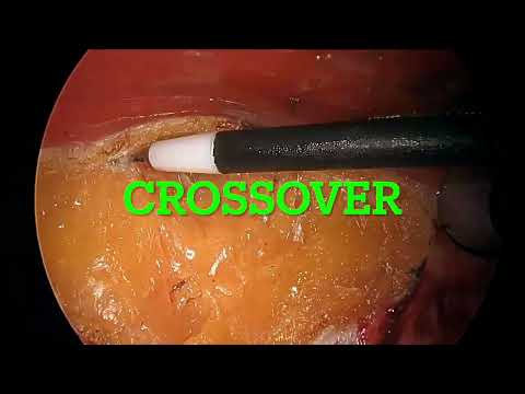 eTEP RS for combined umbilical with supraumbilical divarication & inguinal hernia