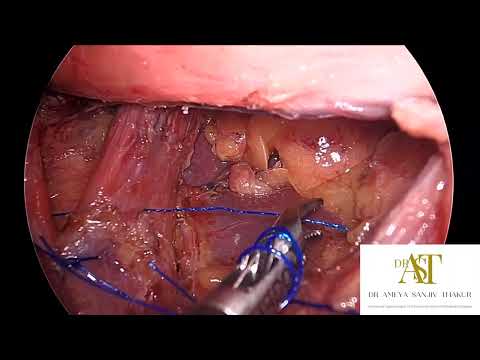 Laparoscopic Anti Reflux Procedure ( Toupet Fundoplication )