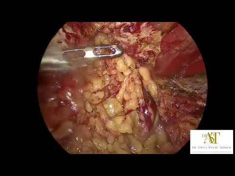 Laparoscopic 3 port e- TEP RS for obstructed umbilical hernia - 4K
