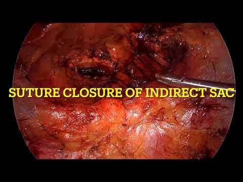 eTEP FOR CONCOMITANT VENTRAL AND INGUINAL HERNIA