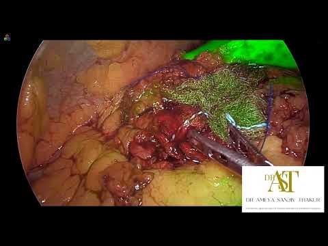 DIFFICULT LAPAROSCOPIC CHOLECYSTECTOMY WITH ICG IMAGING